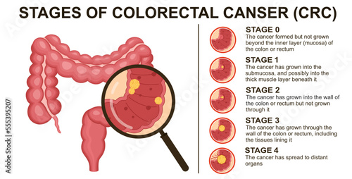 Stages of colorectal cancer CRC. Colon cancer. Colorectal oncology tumor. Bowel cancer.	 photo