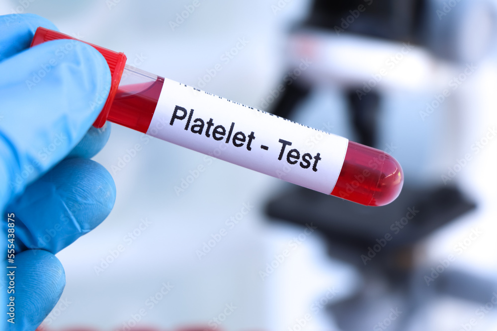 Obraz premium platelet test to look for abnormalities from blood