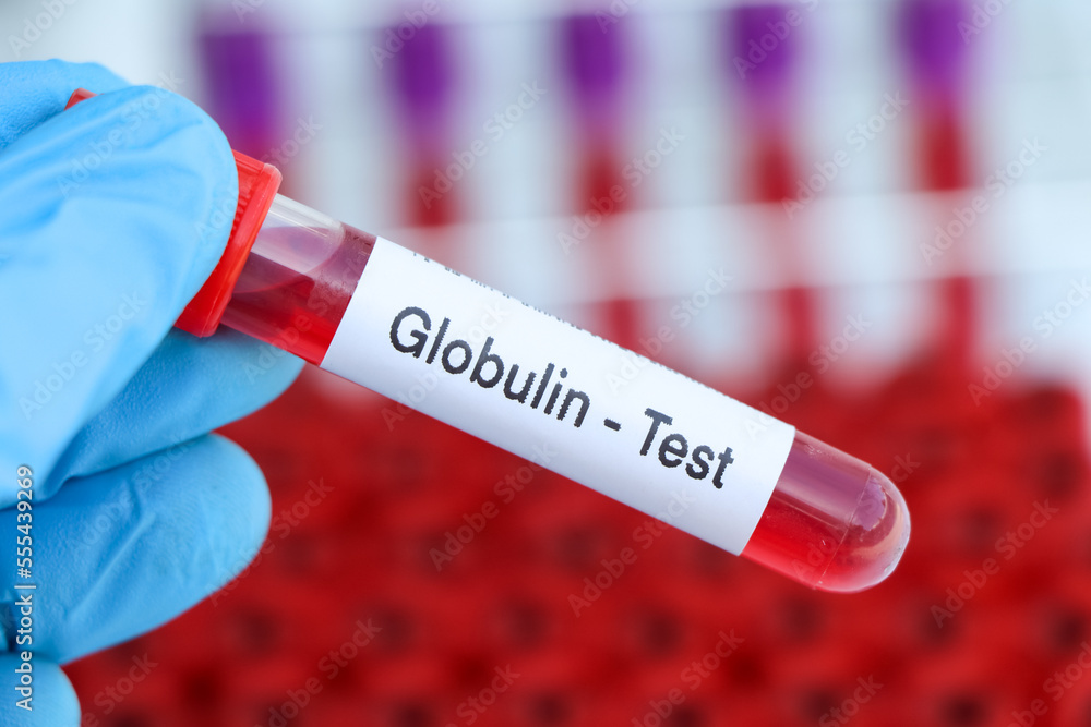 Obraz premium Globulin test to look for abnormalities from blood