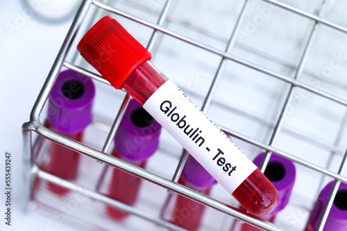 Globulin test to look for abnormalities from blood photo