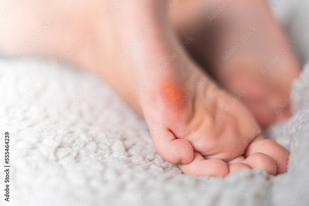 Close up of calluses. Problem skin on the steps of a teenager Close up of calluses. Problem skin on the steps of a teenager