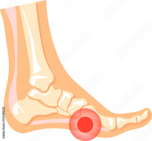 Leg pain. Red spot in human foot. Medical illustration