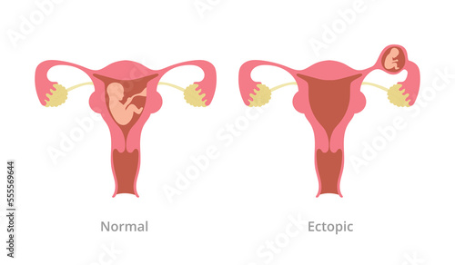 ectopic pregnancy pregnancy problem with comparison with normal pregnancy with modern flat style photo