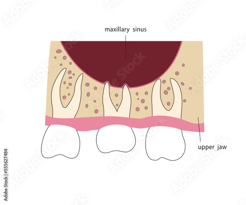 Dental roots in maxillary sinus. Medical illustration in flat style.