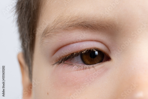 Fototapeta Naklejka Na Ścianę i Meble -  Eye of a child with conjunctivitis, inflammation of the conjunctiva, close-up.