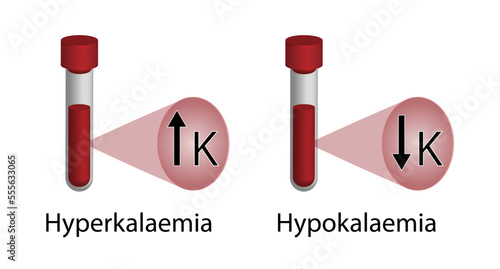 Hyperkalaemia, high plasma potassium level  and Hypokalaemia, low plasma potassium level. Potassium K excess and deficit electrolyte disorders, blood test tube, Scientific design. Vector illustration.