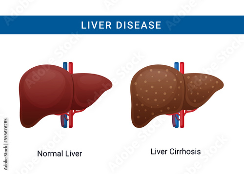 Liver disease illustration, normal liver and liver cirrhosis vector