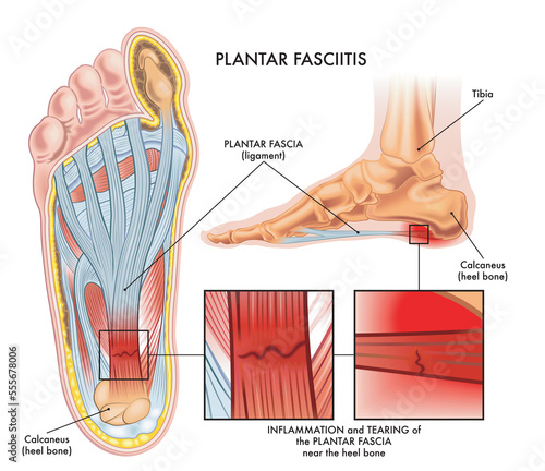 Medical illustration showing section of foot with symptoms of plantar fasciitis with two magnified details of affected points, and annotations.