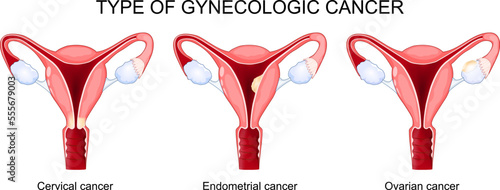 Type of gynecologic cancer. Ovarian, Endometrial, and Cervical cancer. photo