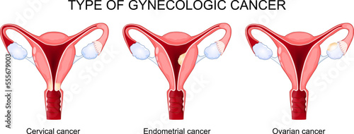 Type of gynecologic cancer. Ovarian, Endometrial, and Cervical cancer.