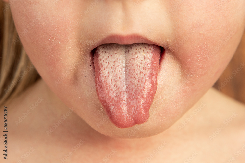 Strawberry tongue of a small child with scarlet fever caused by group A