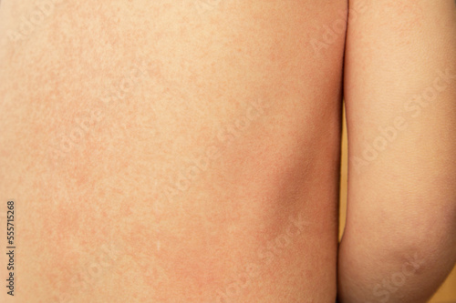 Rash on the back of a small child with scarlet fever caused by group A streptococcus