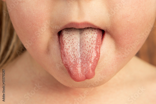 Fotografia, Obraz Strawberry tongue of a small child with scarlet fever caused by group A streptoc