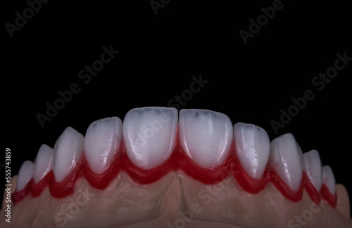 dental work of veneer teeth model photo