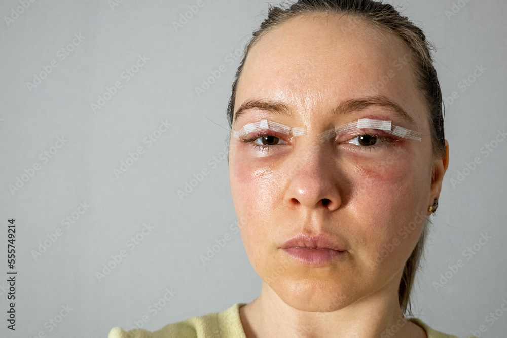 woman face after plastic surgery, blepharoplasty operation, swelling eye bags, incisions with removable stitches, swollen skin and bruised eyelids. Cosmetic surgery to remove excess skin or fat woman face after plastic surgery, blepharoplasty operation, swelling eye bags, incisions with removable stitches, swollen skin and bruised eyelids. Cosmetic surgery to remove excess skin or fat
