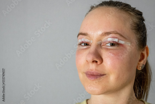 woman face after plastic surgery, blepharoplasty operation, swelling eye bags, incisions with removable stitches, swollen skin and bruised eyelids. Cosmetic surgery to remove excess skin or fat 