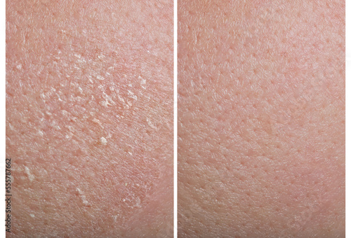 Collage demonstrating comparison of dry and moisturized human skin, closeup photo