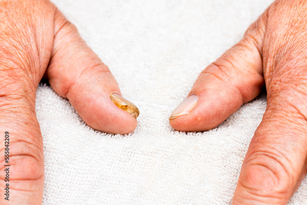 Nail fungus infection on the thumb finger.Fungal infection on nail hand,finger with
