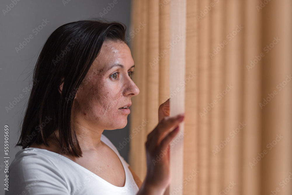 Photo of woman with dry skin looking in the window. Photo of woman with dry skin looking in the window.