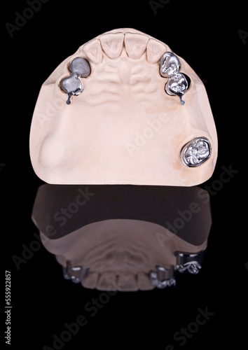 Different metal frames of ceramic-metal crowns