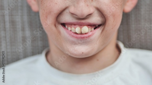 Bild auf Leinwand The boy's front crooked teeth.