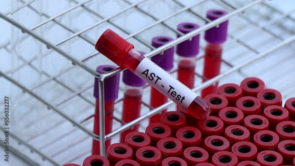 Vidéo Stock AST test to look for abnormalities from blood, blood sample
