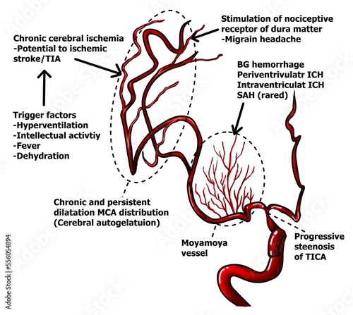 Pathophysiologic progression Moyamoya disease (MMD) including both ischemic and hemorrhagic complications. photo