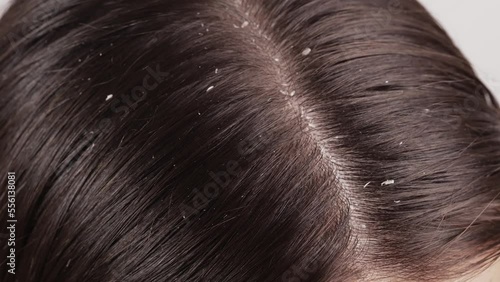 Hair of a woman with dandruff photo
