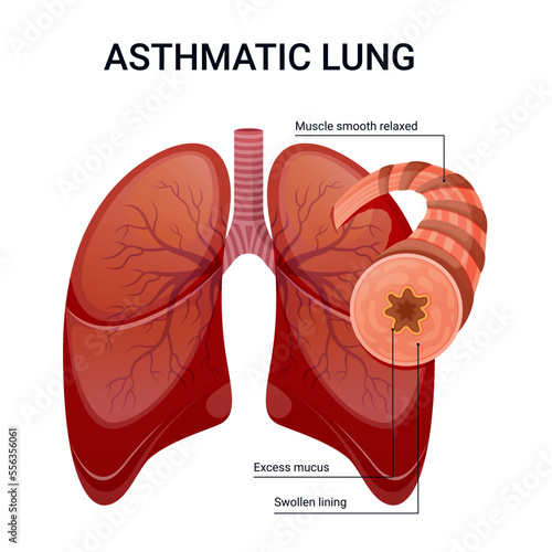 Asthma lung vector diagram illustration