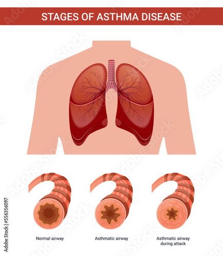 Stages of asthma vector illustration