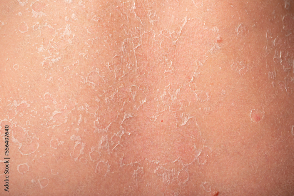 Fototapeta premium Sunburn, close-up of human skin. Flaky skin from allergies, peeling or eczema. Dry skin in need of treatment and hydration.