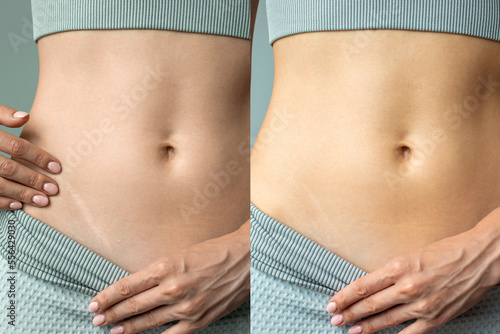 Bild auf Leinwand An advertisement for a cream, ointment or gel for removing scars after surgery and cuts