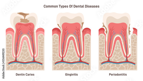 Dental disease set. Dentin caries, gingivitis and periodontitis. Oral cavity