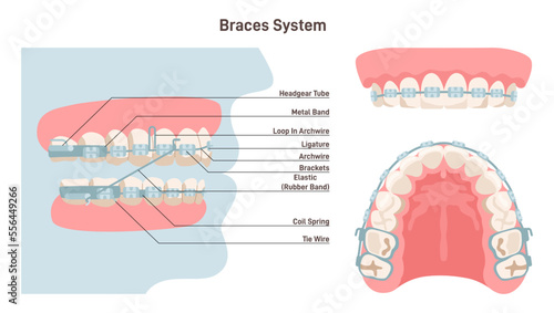 Dental braces system. Installed brackets system side, front and bottom