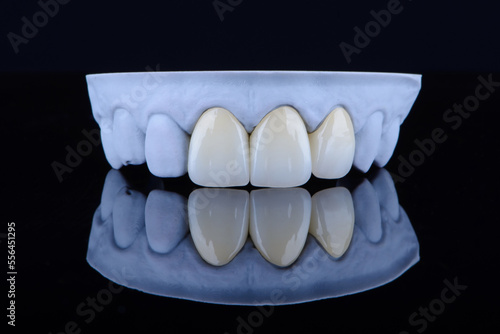High-quality naturally dental single crowns made of zirconium for fixation to the frontal teeth of upper jaw. photo