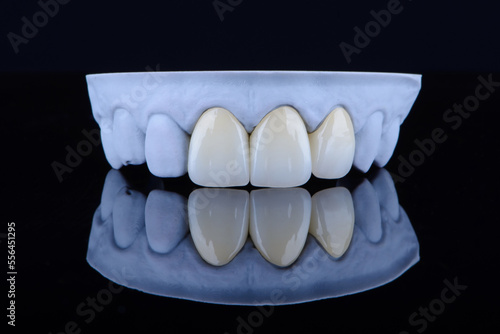 Canvas Print High-quality naturally dental single crowns made of zirconium for fixation to the frontal teeth of upper jaw