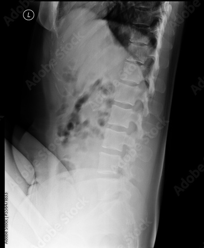 Lumbosacral spine x-ray. Lateral view. Lumbar lordosis with mild right convex scoliosis around the thoracolumbar transition. Normal vertebral body configuration. Intervertebral spaces are unaffected. photo