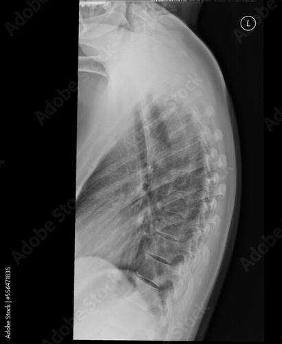 Thoracic spine x-ray. Lateral view. A kyphosis with mild right convex scoliosis around the thoracolumbar transition. Normal vertebral body configuration. Intervertebral spaces are unaffected. photo