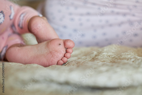 Close-up of a wart on a child's foot, a new wart is visible on the big toe..