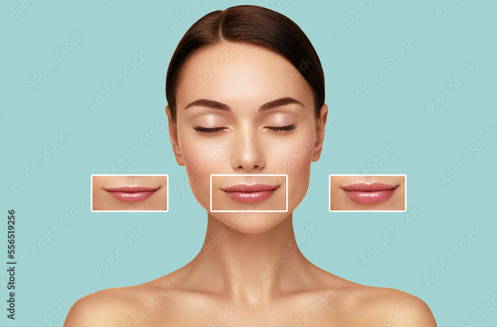 Hyaluronic acid injection. Women lips correction before and after