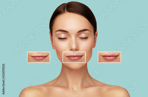 Quadro em tela Hyaluronic acid injection