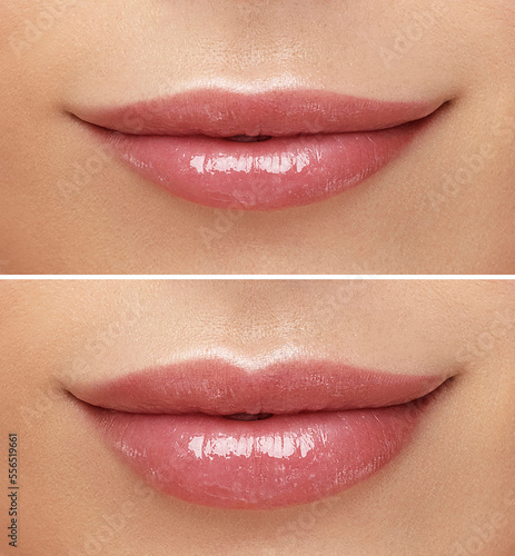 Women lips correction before and after comparison. Hyaluronic acid injection. Beauty lip treatment procedure.