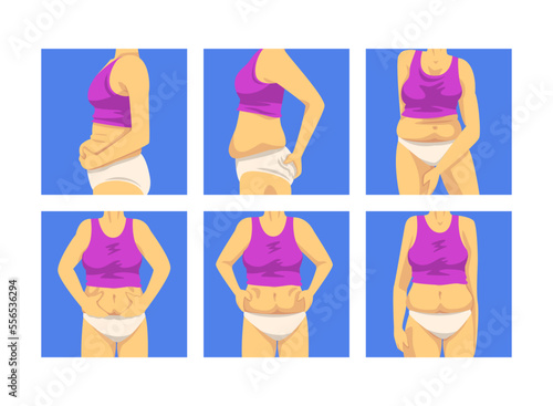 Female Torso with Sagging Belly and Soft Muscles Vector Set