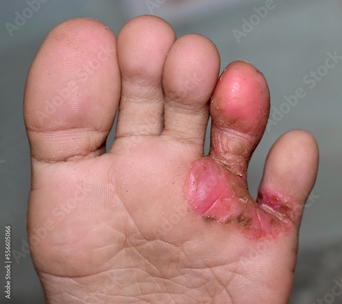 Tinea Pedis or or Athlete's foot or Fungal Infection on right toes of Southeast Asian, Burmese child in Clinic. It is a superficial dermatophyte infection limited to glabrous skin of the leg. © ZayNyi