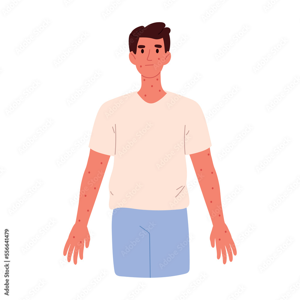 Rash on the skin. Autoimmune disease, chickenpox, atopic dermatitis. Rash on the man. Flat vector illustration Rash on the skin. Autoimmune disease, chickenpox, atopic dermatitis. Rash on the man. Flat vector illustration