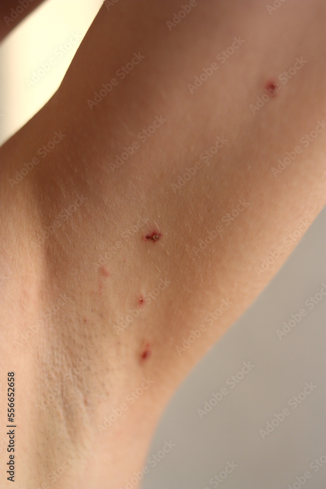 Skin on the armpits after removal of papillomas by laser Skin on the armpits after removal of papillomas by laser