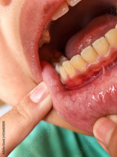 Kid's gum inflammation. red bleeding gums with bum. Close up. Dentistry, dental care.