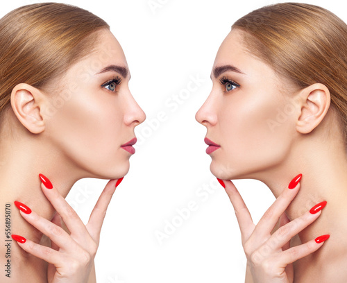 Woman before and after cheekbones shape correction. photo