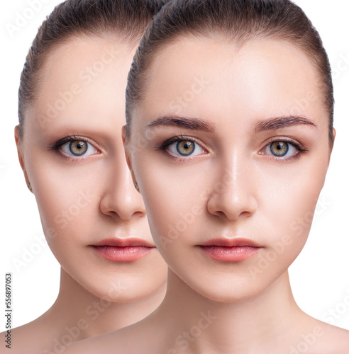 Young woman with bald eyebrows before and after hair transplantation.