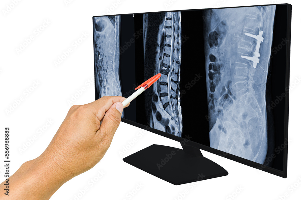 The doctor reported the MRI scans of the lumbar spine compression fracture  Bulging of L1-L2. and Post operation fixed by iron rod and screws. Medical  education concept. Stock Photo